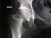800px-Fracture_du_col_du_f%C3%A9mur.jpg