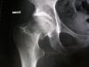 800px-Fracture_du_col_du_f%C3%A9mur~0.jpg